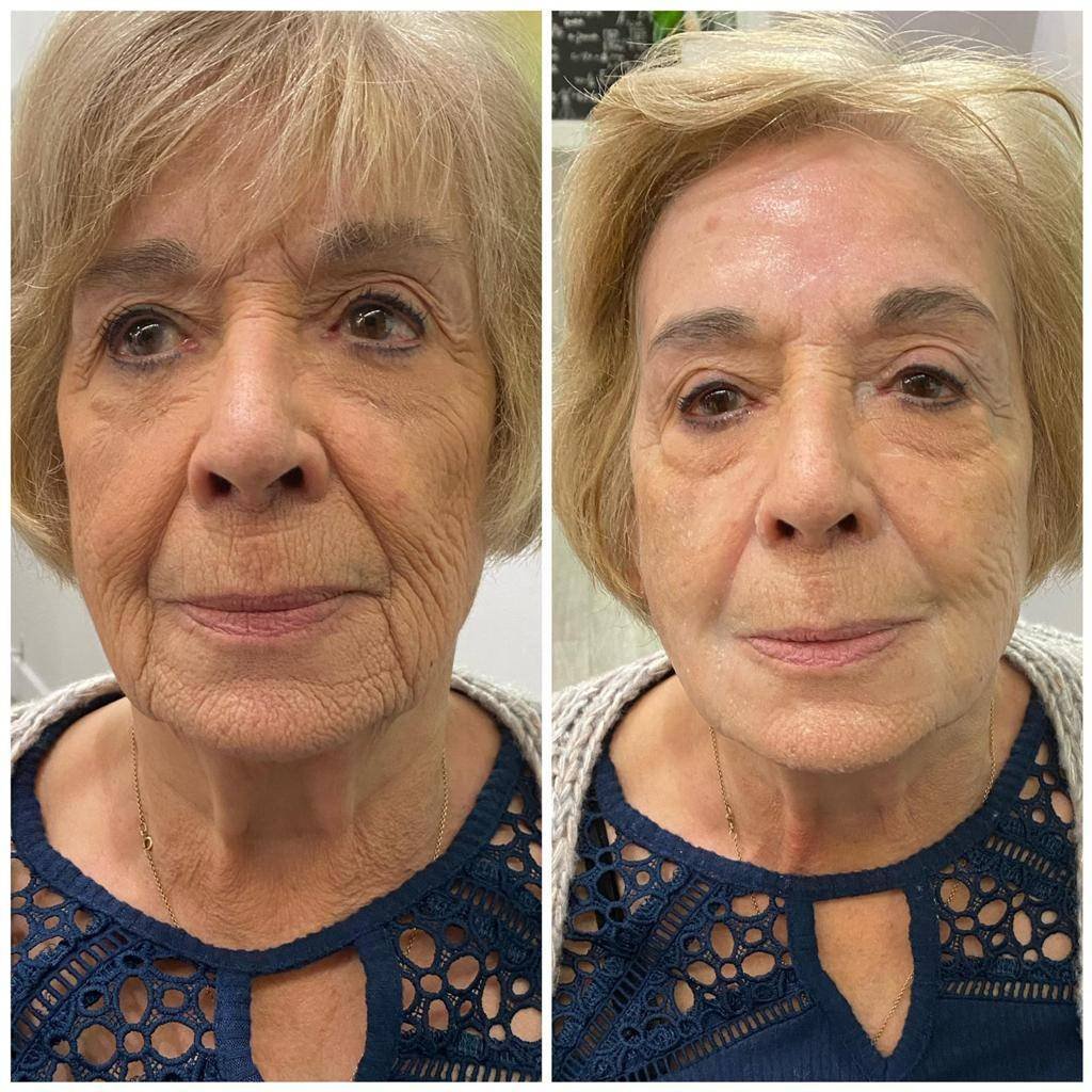 Facial Treatments - Derma Shine Spa